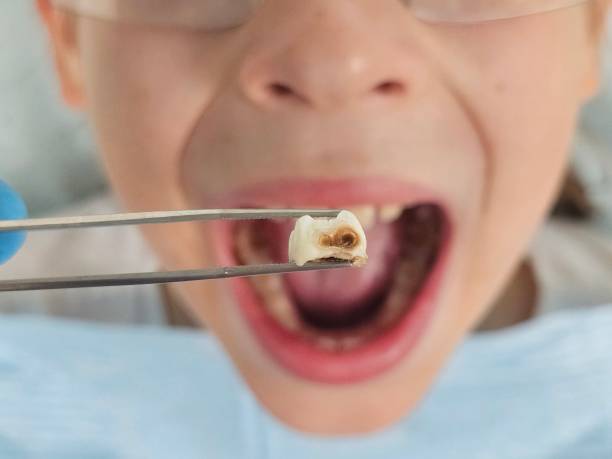 Best Emergency Tooth Extraction in Lopezville, TX
